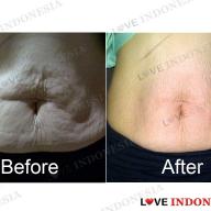 Before & after body tightening program