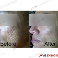 Before & after untuk perawatan wajah