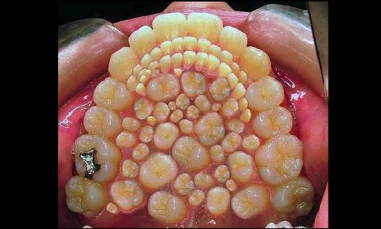 Seram! Viral Foto Mulut Penuh Gigi di Media Sosial, Asli atau Hoax?